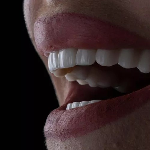 What Are Porcelain Veneers And Resin Veneers?